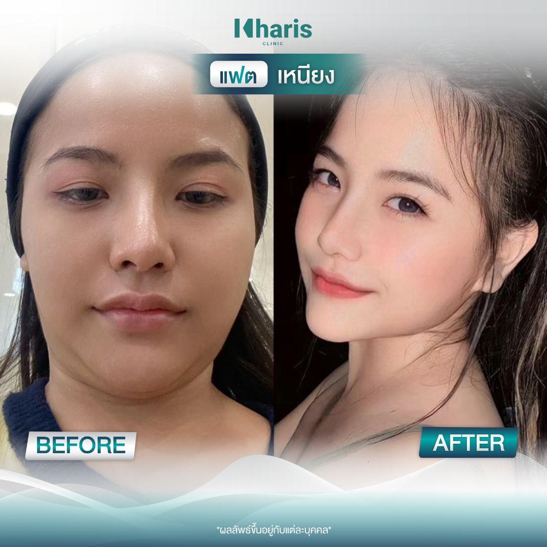 Fat Reduction review 2