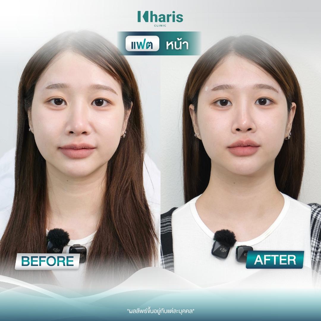 Fat Reduction review 14