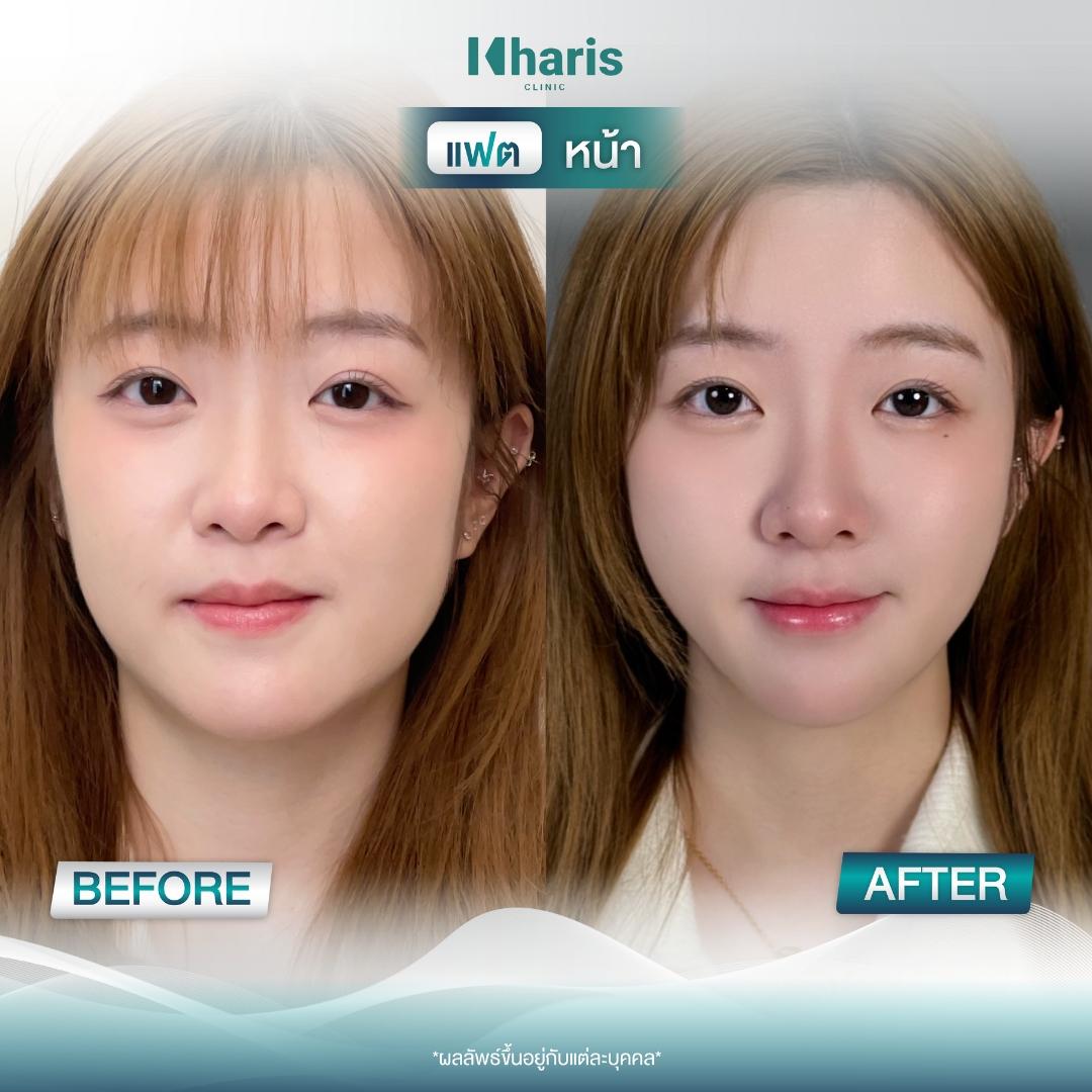 Fat Reduction review 15