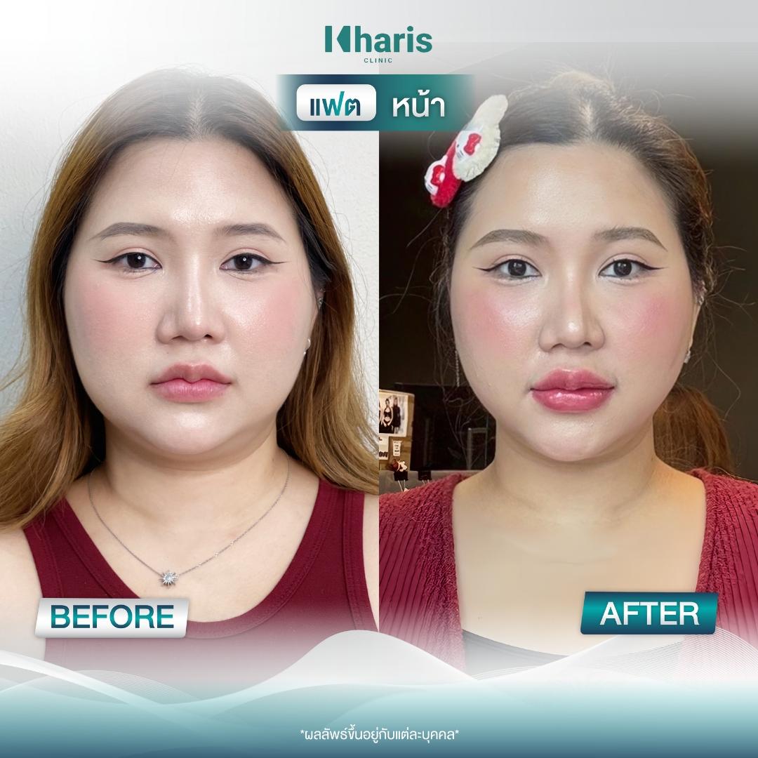 Fat Reduction review 16