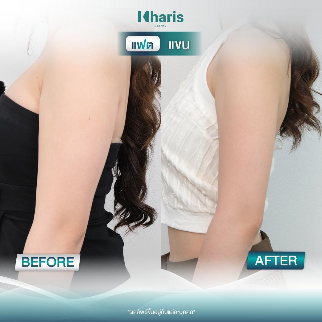 Fat Reduction review 17