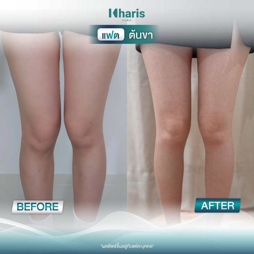 Fat Reduction review 20