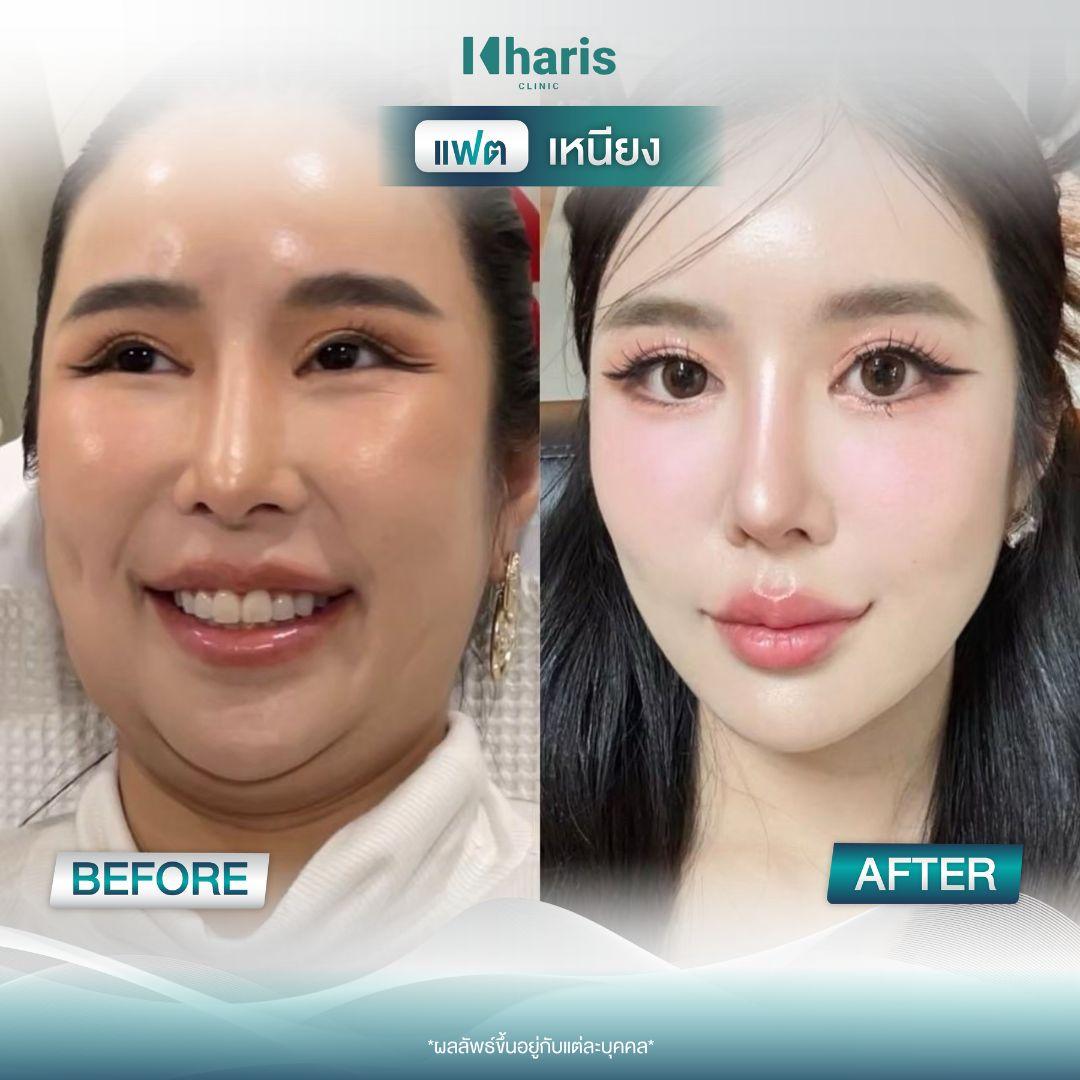 Fat Reduction review 3