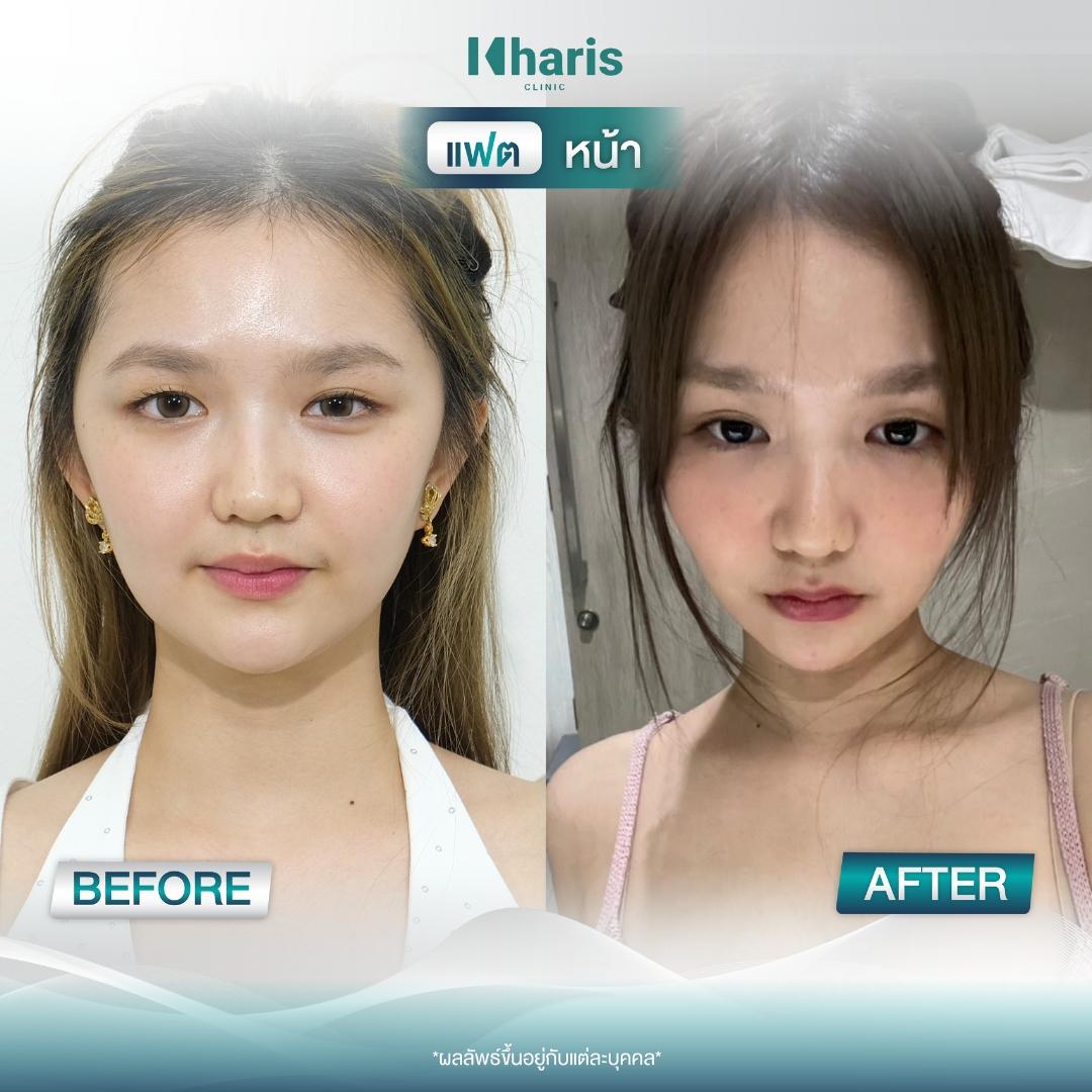 Fat Reduction review 21