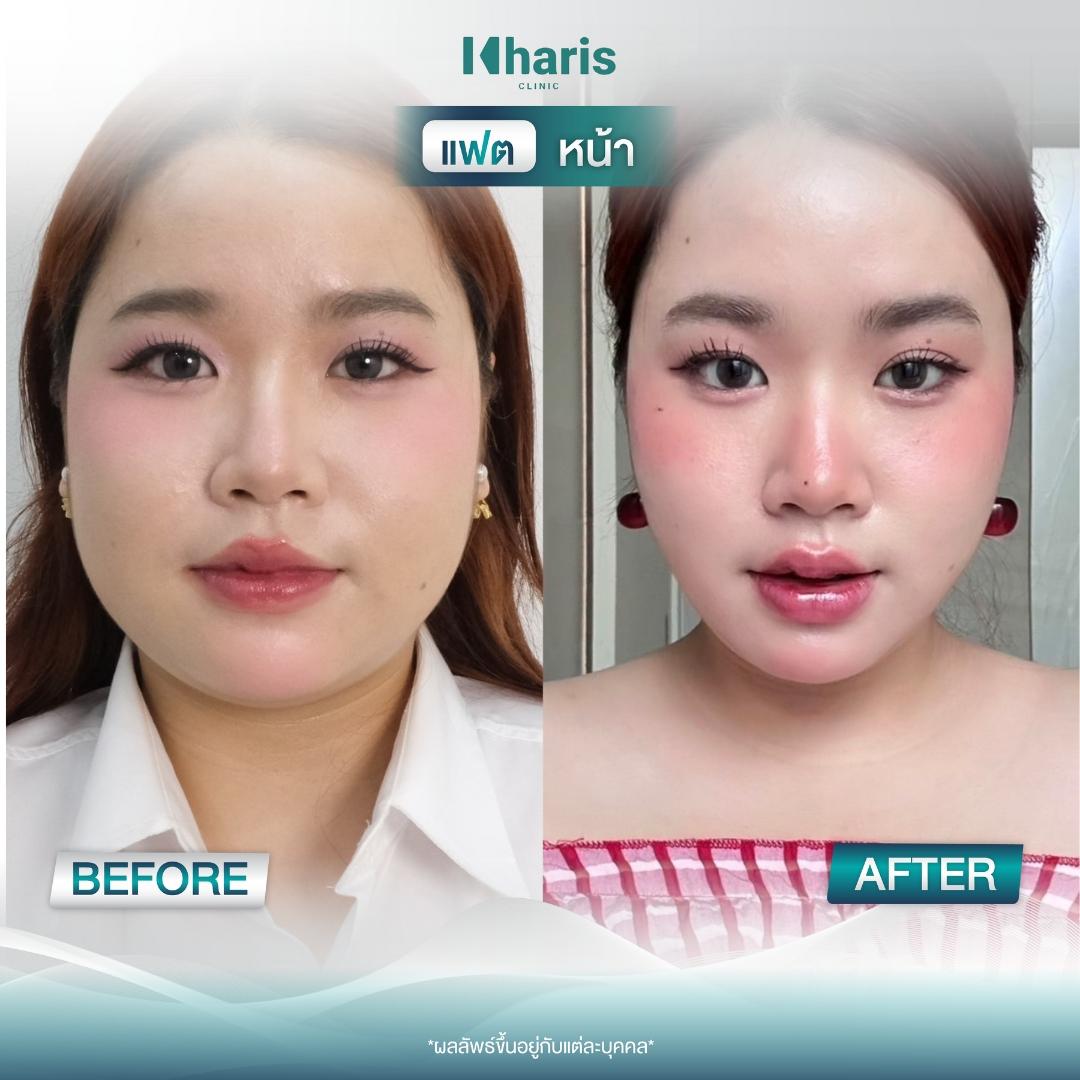 Fat Reduction review 23