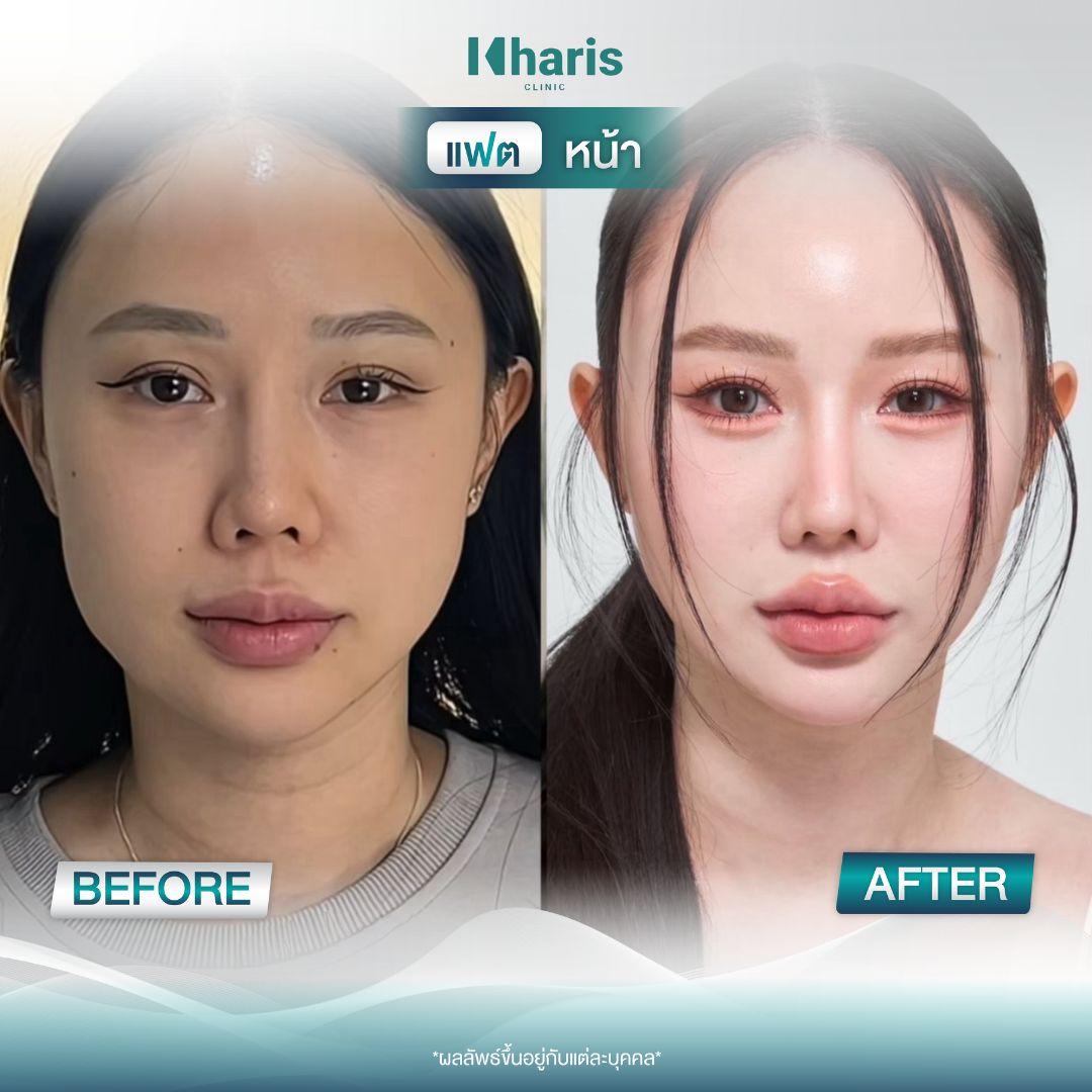 Fat Reduction review 4