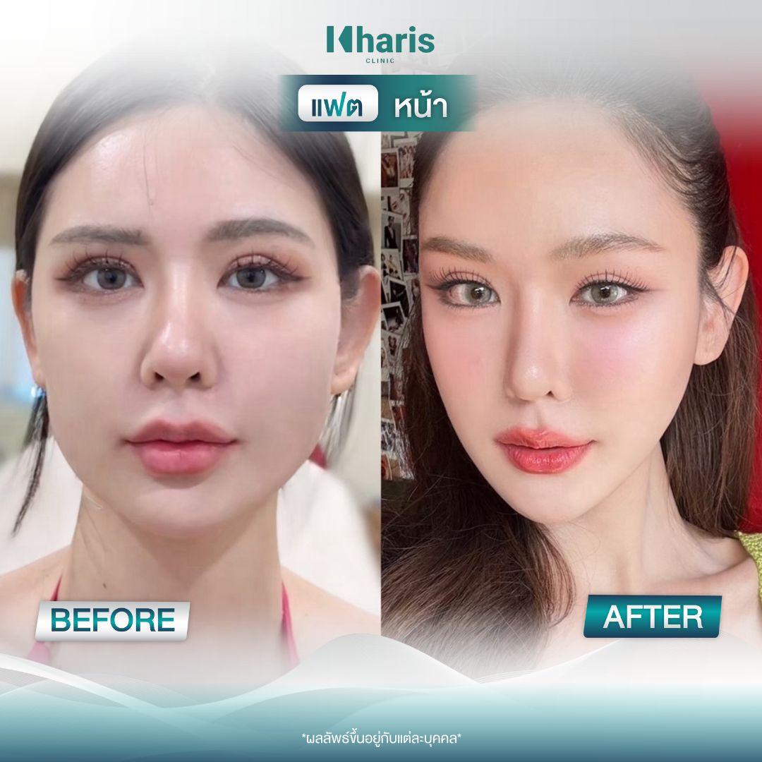 Fat Reduction review 5