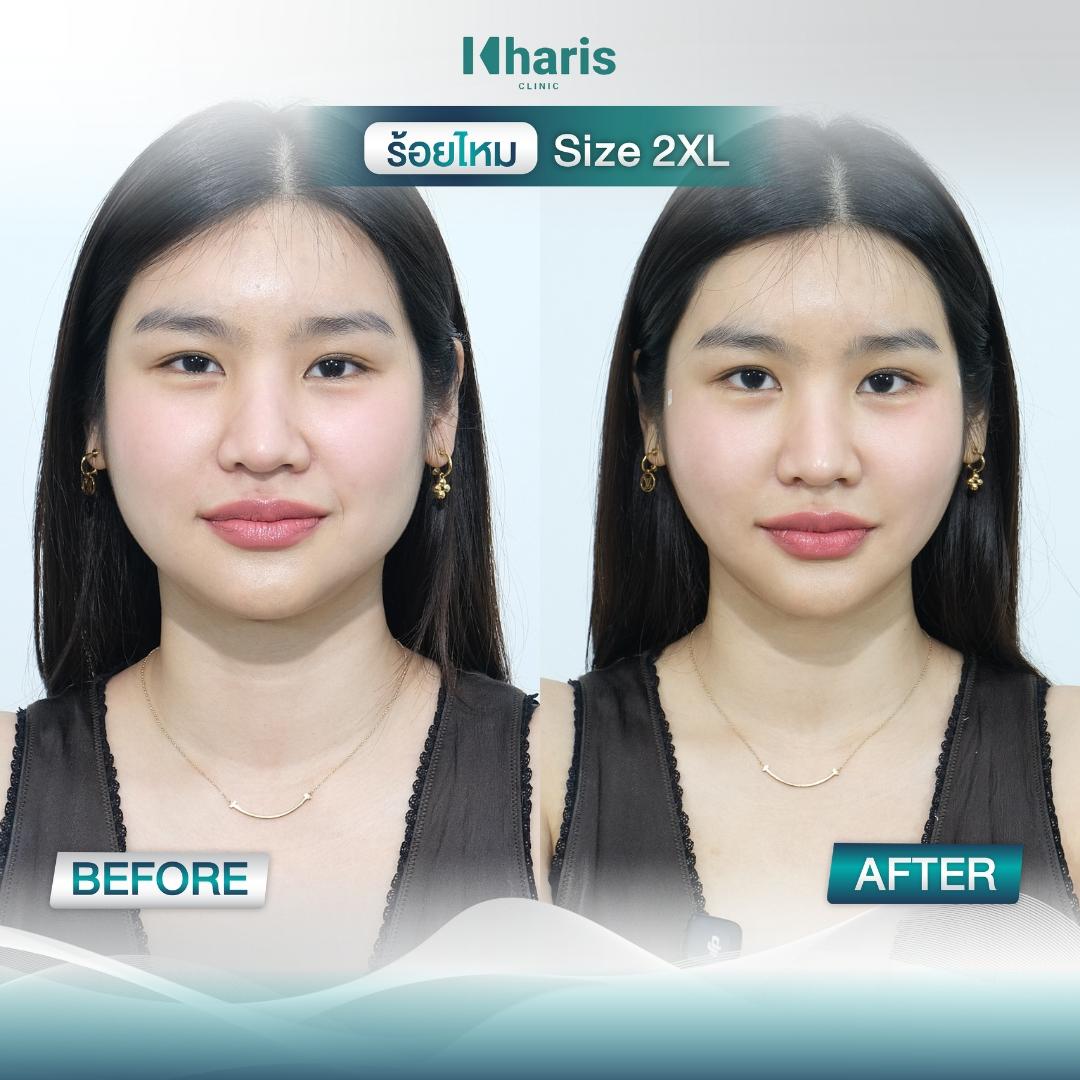 Thread Lift review 2