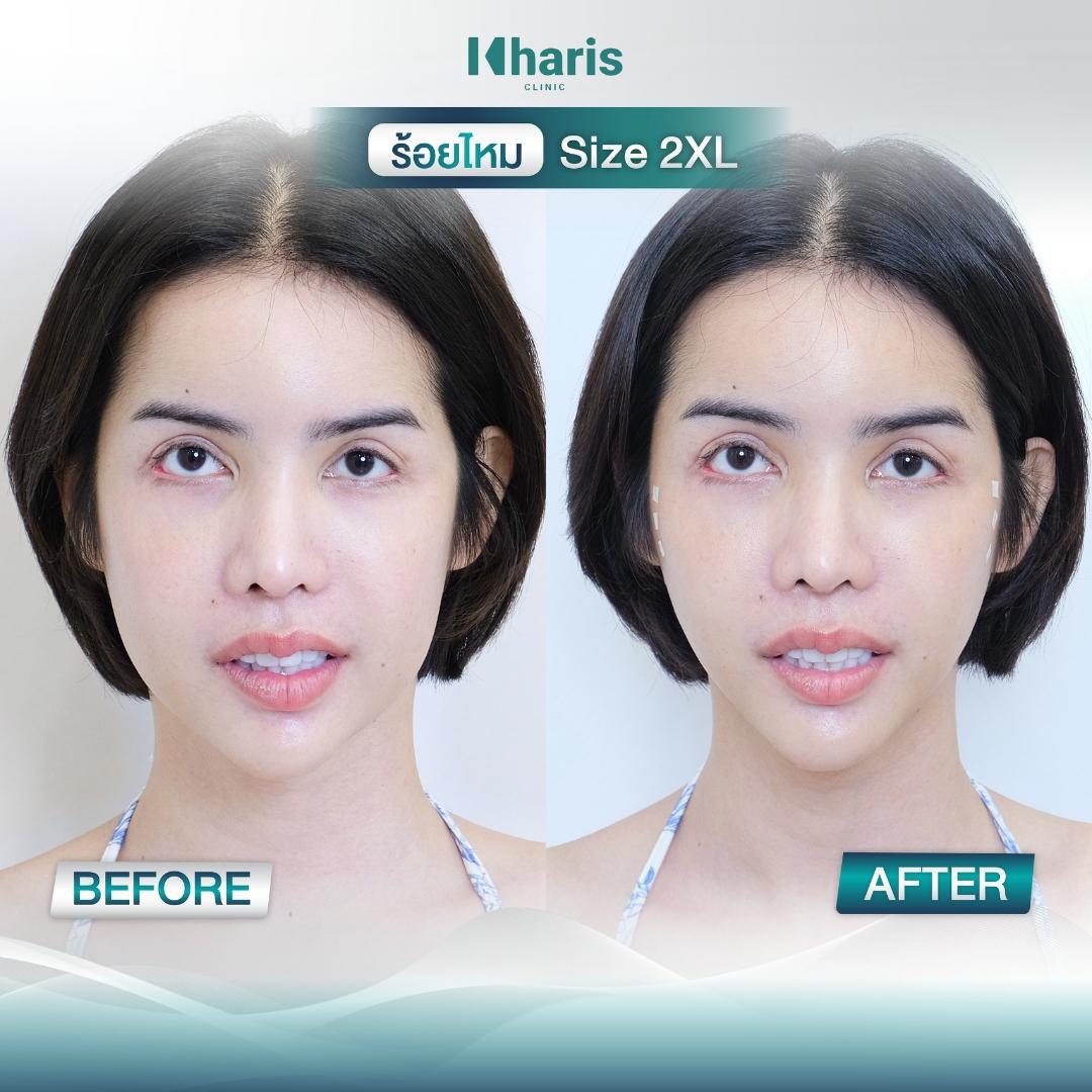 Thread Lift review 3