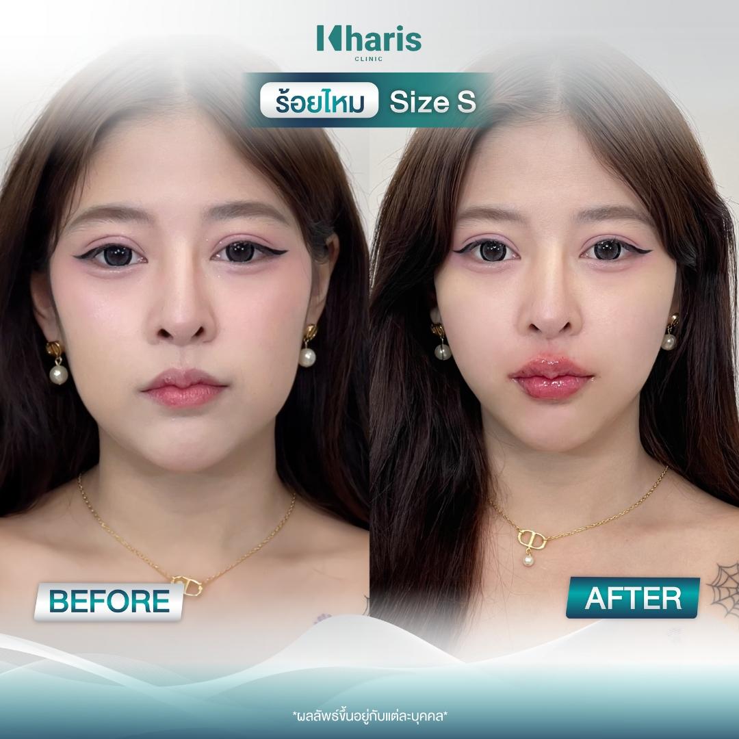 Thread Lift review 4