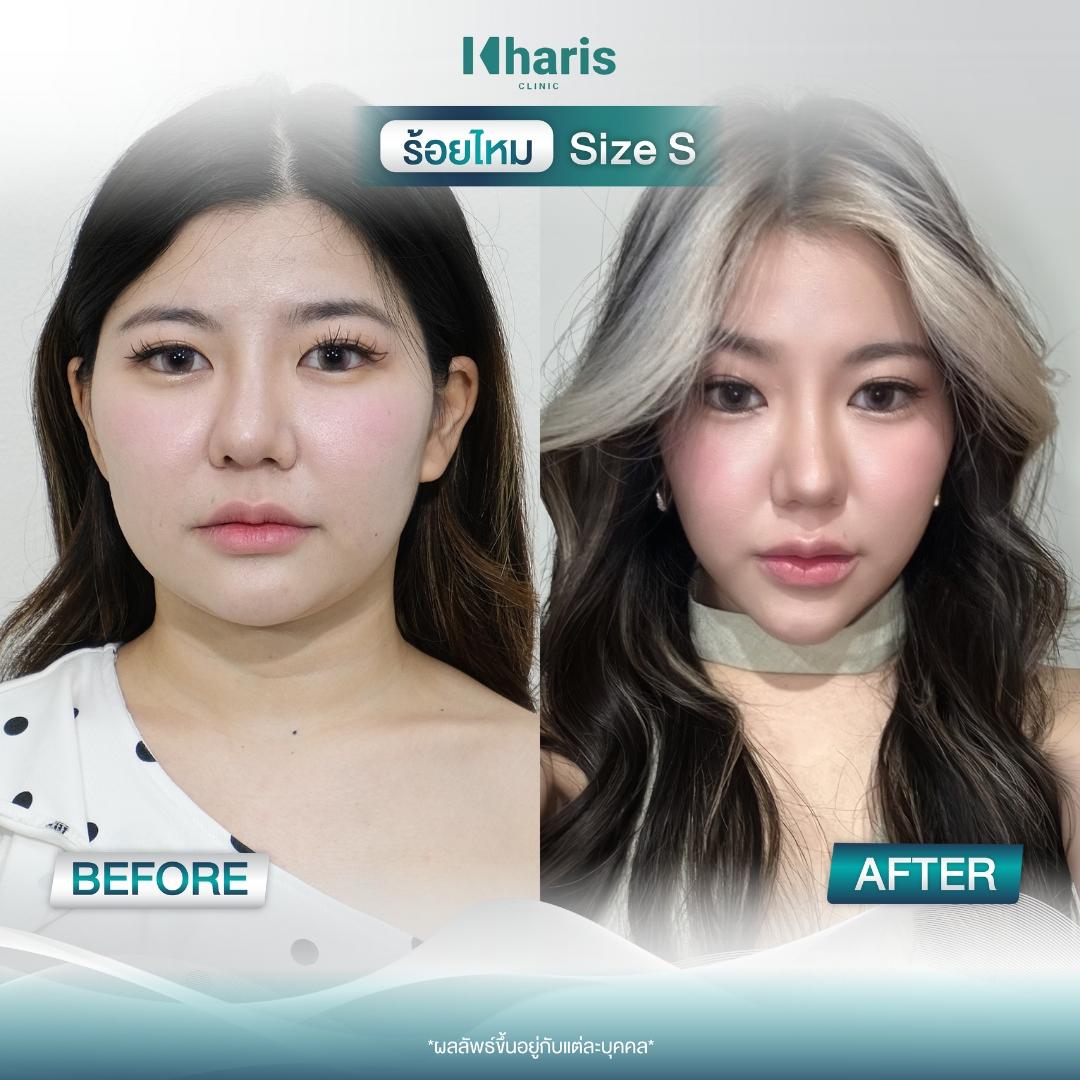 Thread Lift review 5