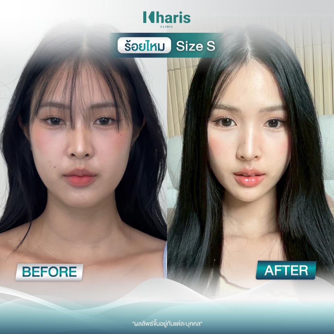 Thread Lift review 6