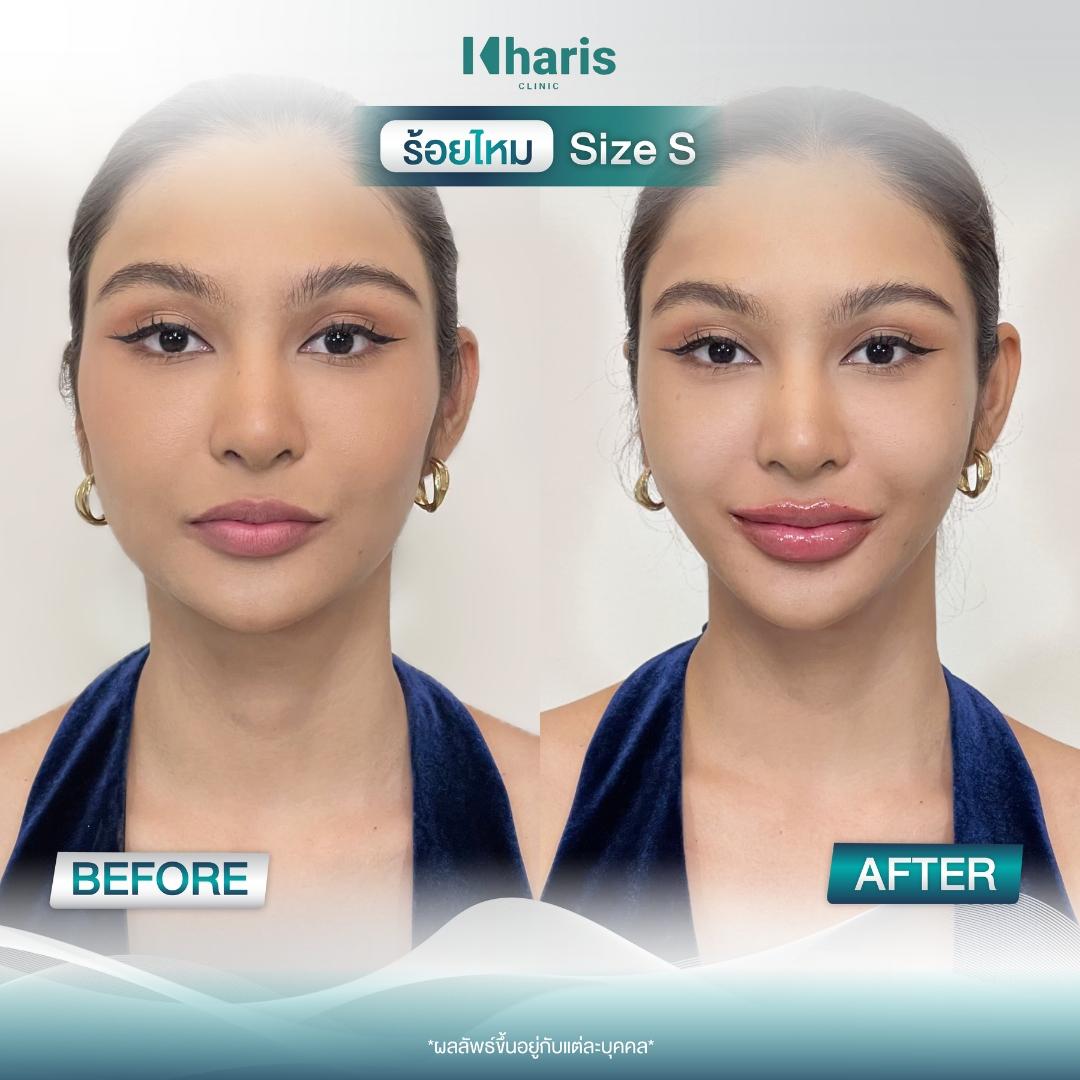 Thread Lift review 7