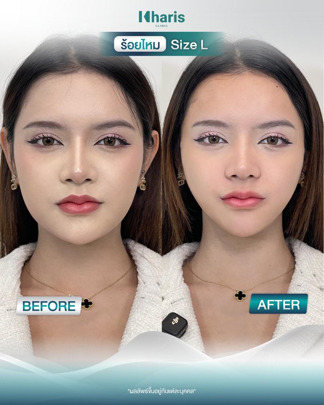 Thread Lift review 8