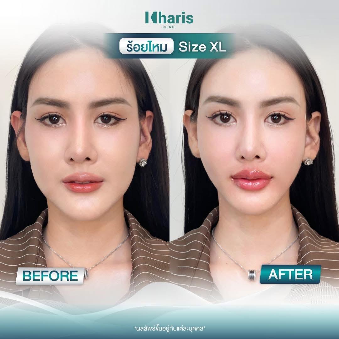 Thread Lift review 9