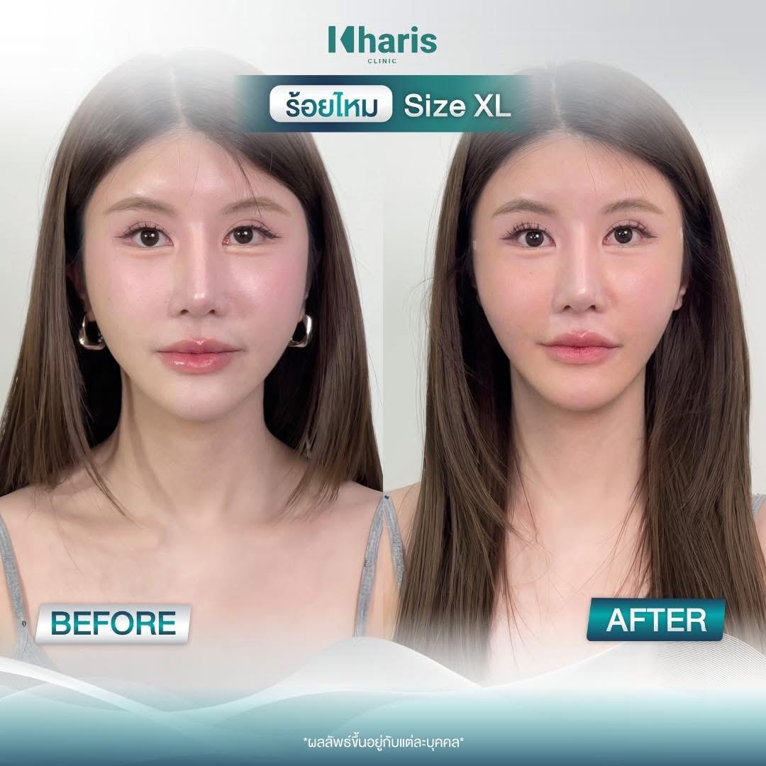 Thread Lift review 10