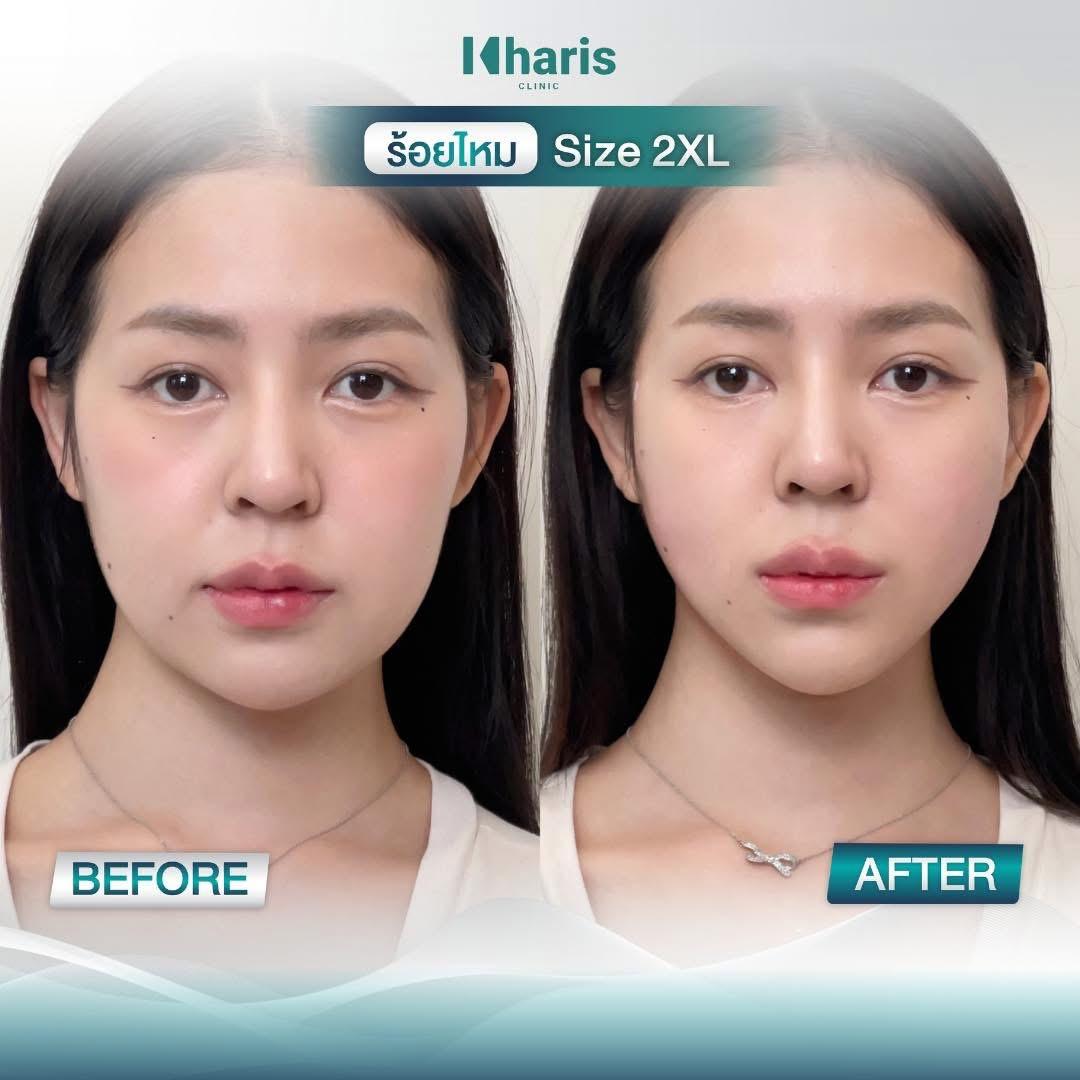 Thread Lift review 11