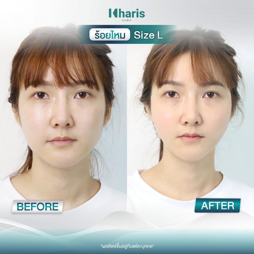 Thread Lift review 12