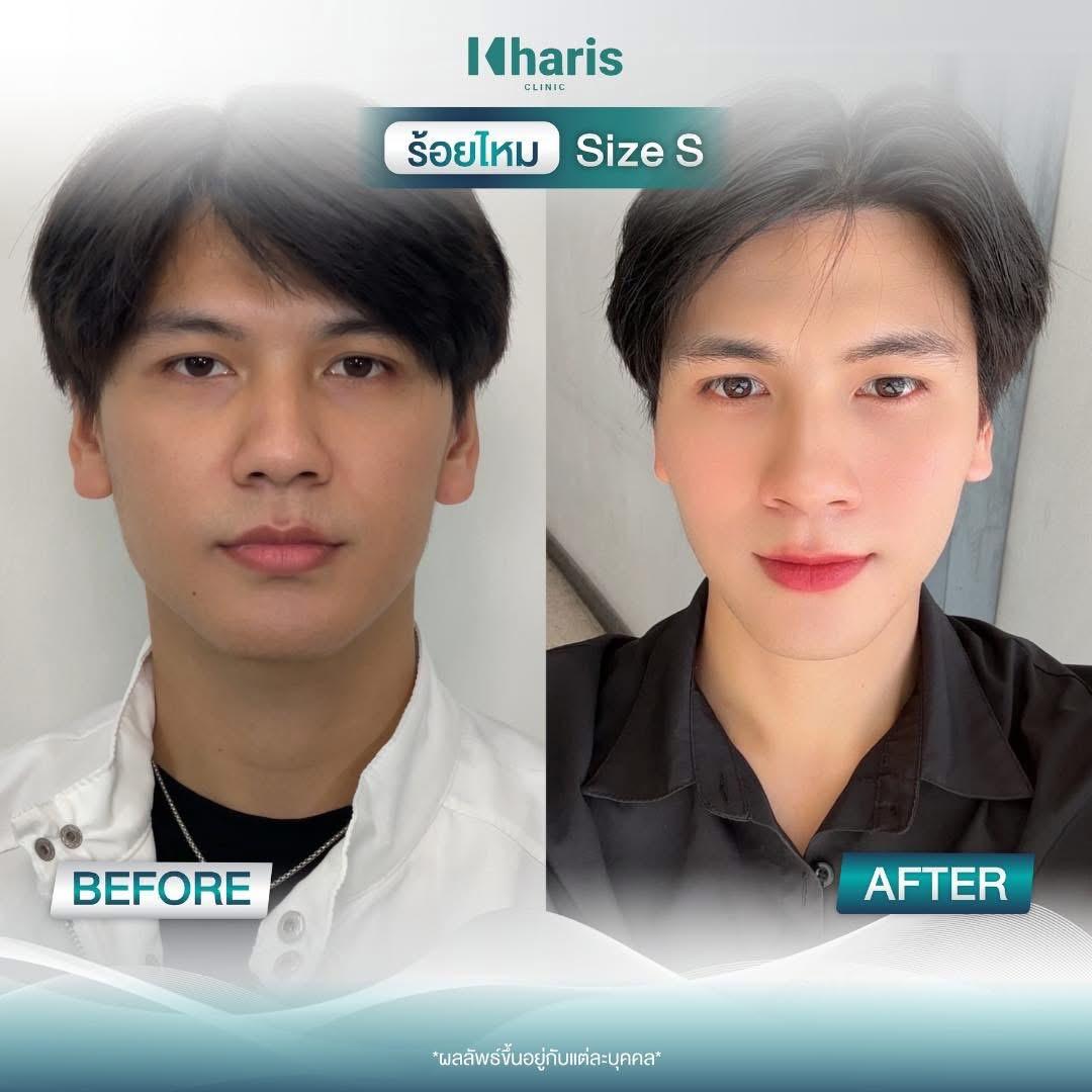 Thread Lift review 13