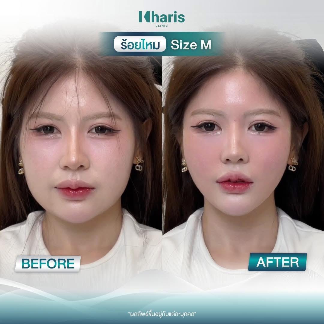 Thread Lift review 14