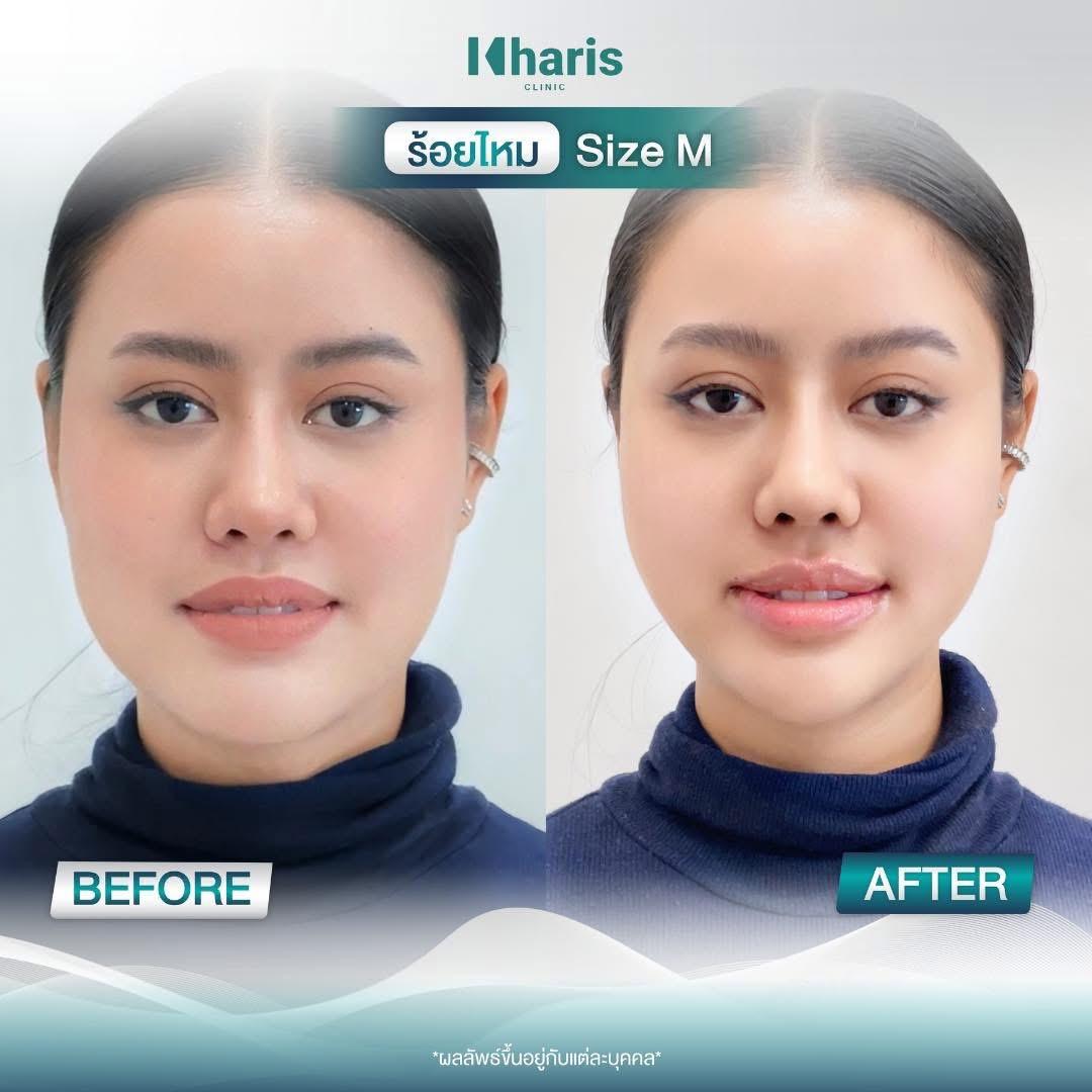 Thread Lift review 15