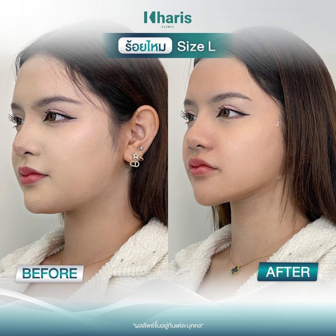 Thread Lift review 16