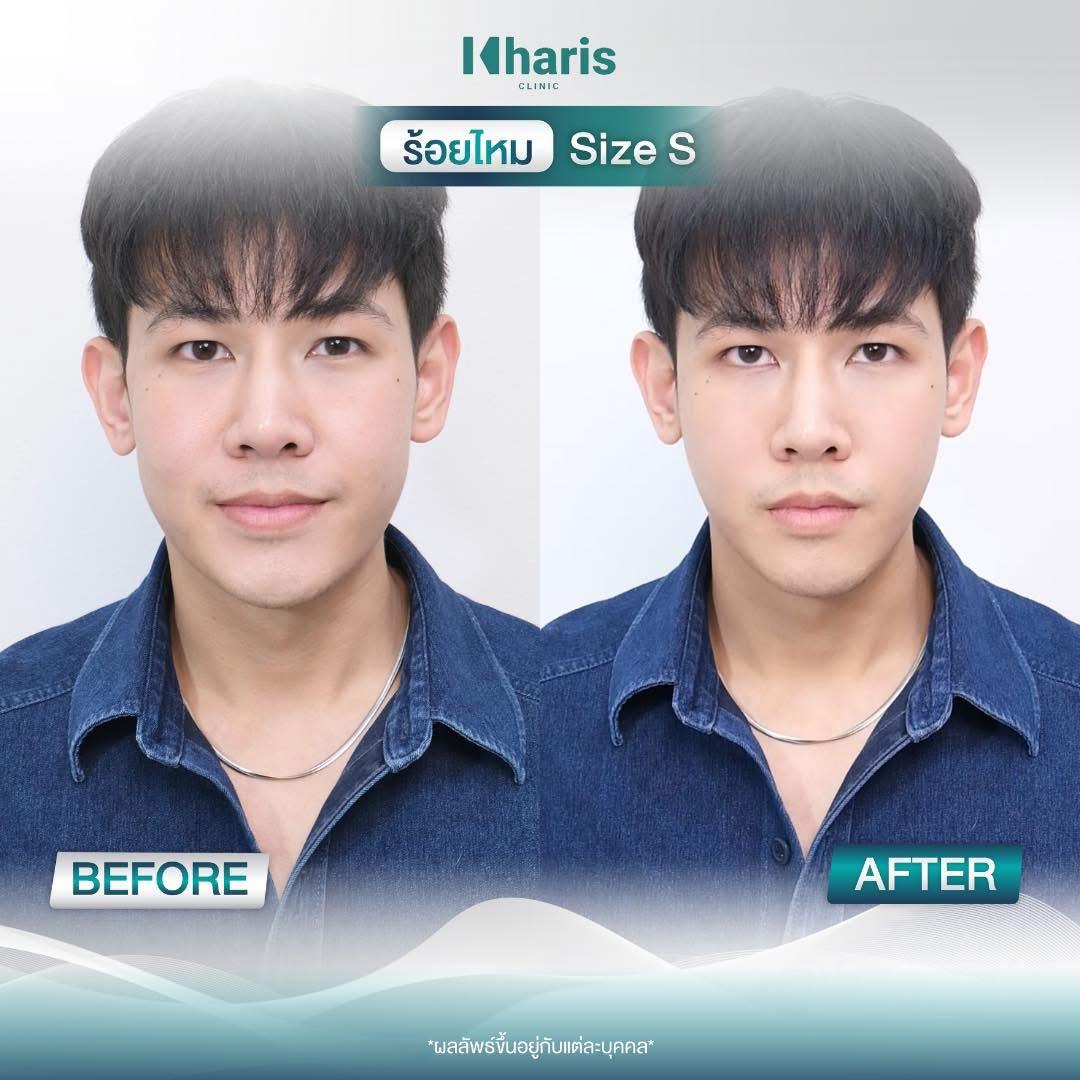 Thread Lift review 17