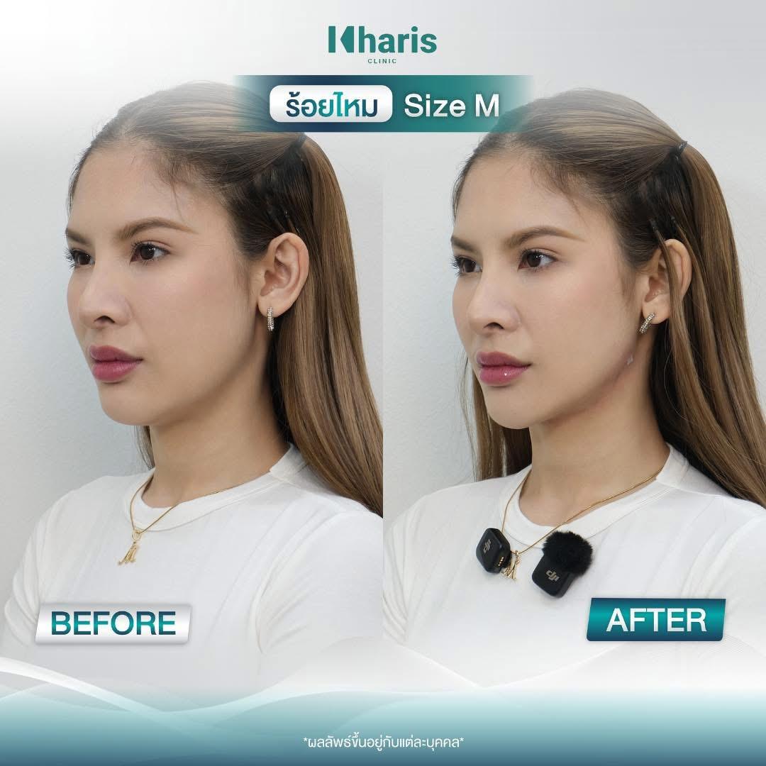 Thread Lift review 18