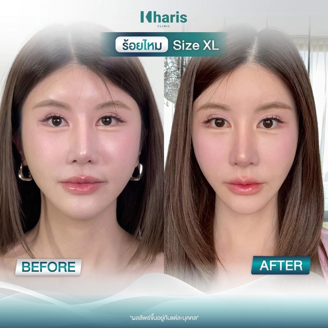 Thread Lift review 19