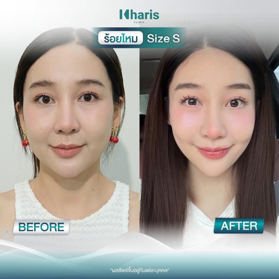 Thread Lift review 20