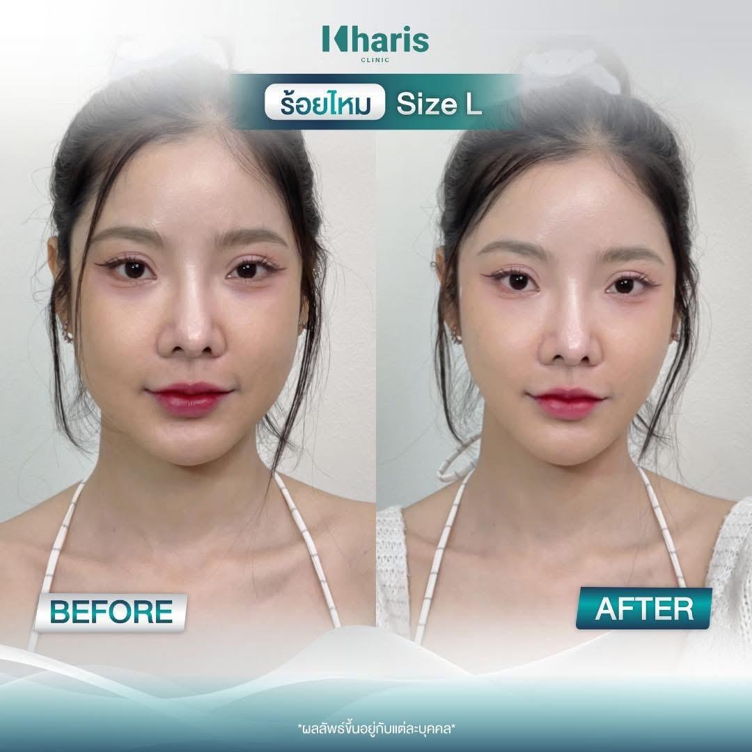 Thread Lift review 21