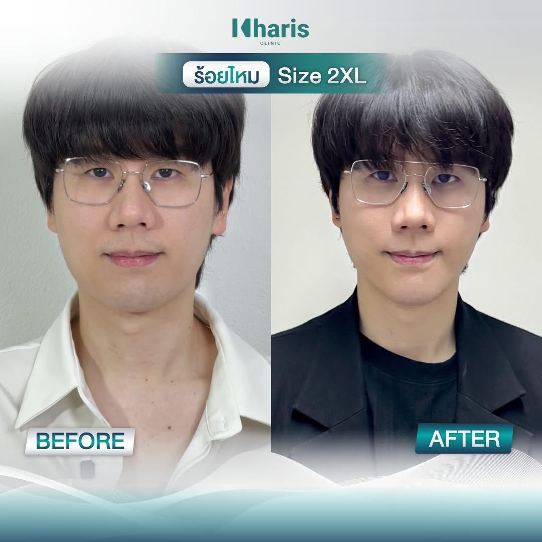 Thread Lift review 22