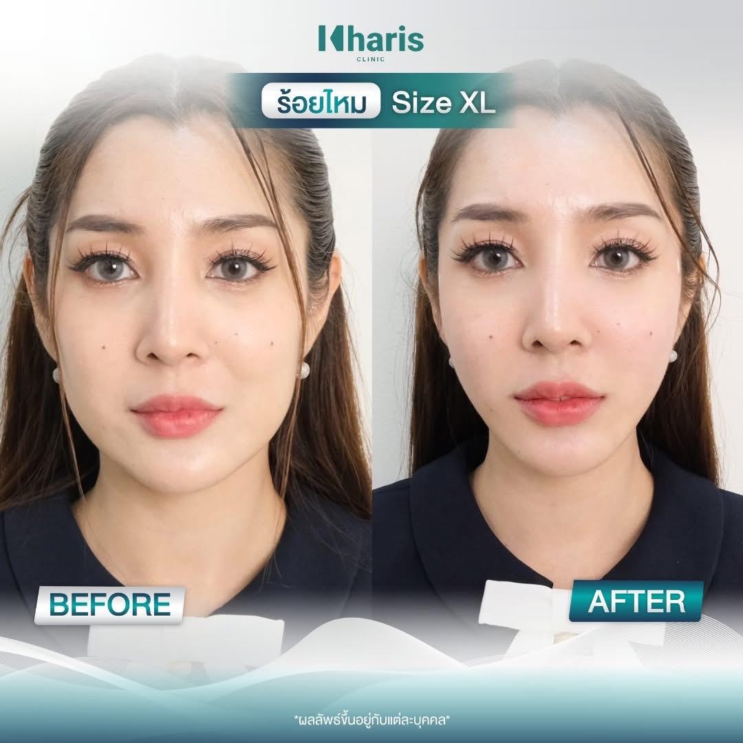 Thread Lift review 23