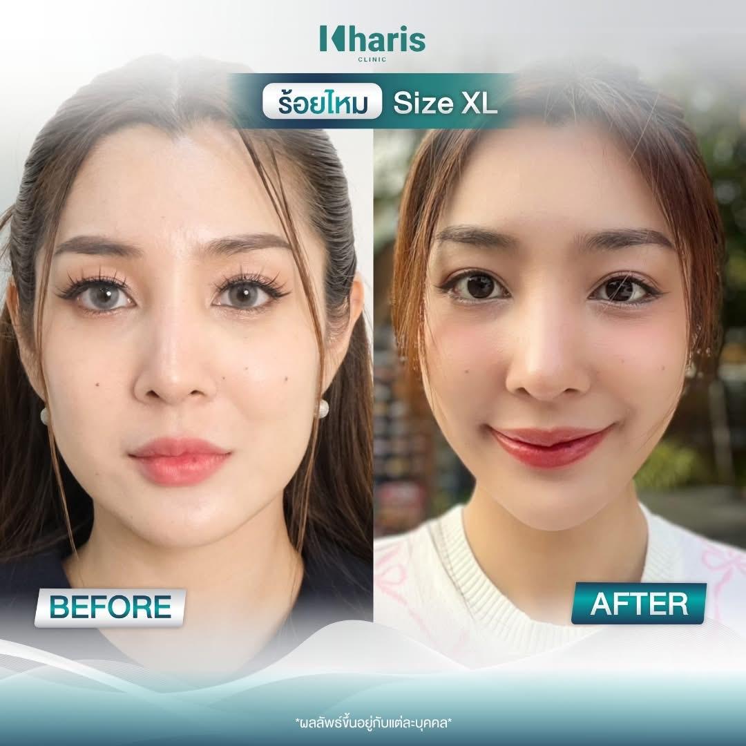 Thread Lift review 24