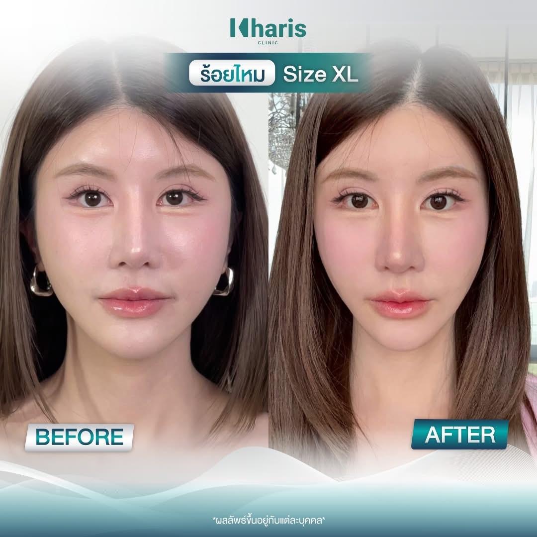 Thread Lift review 25