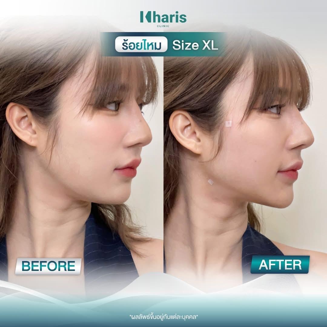 Thread Lift review 26