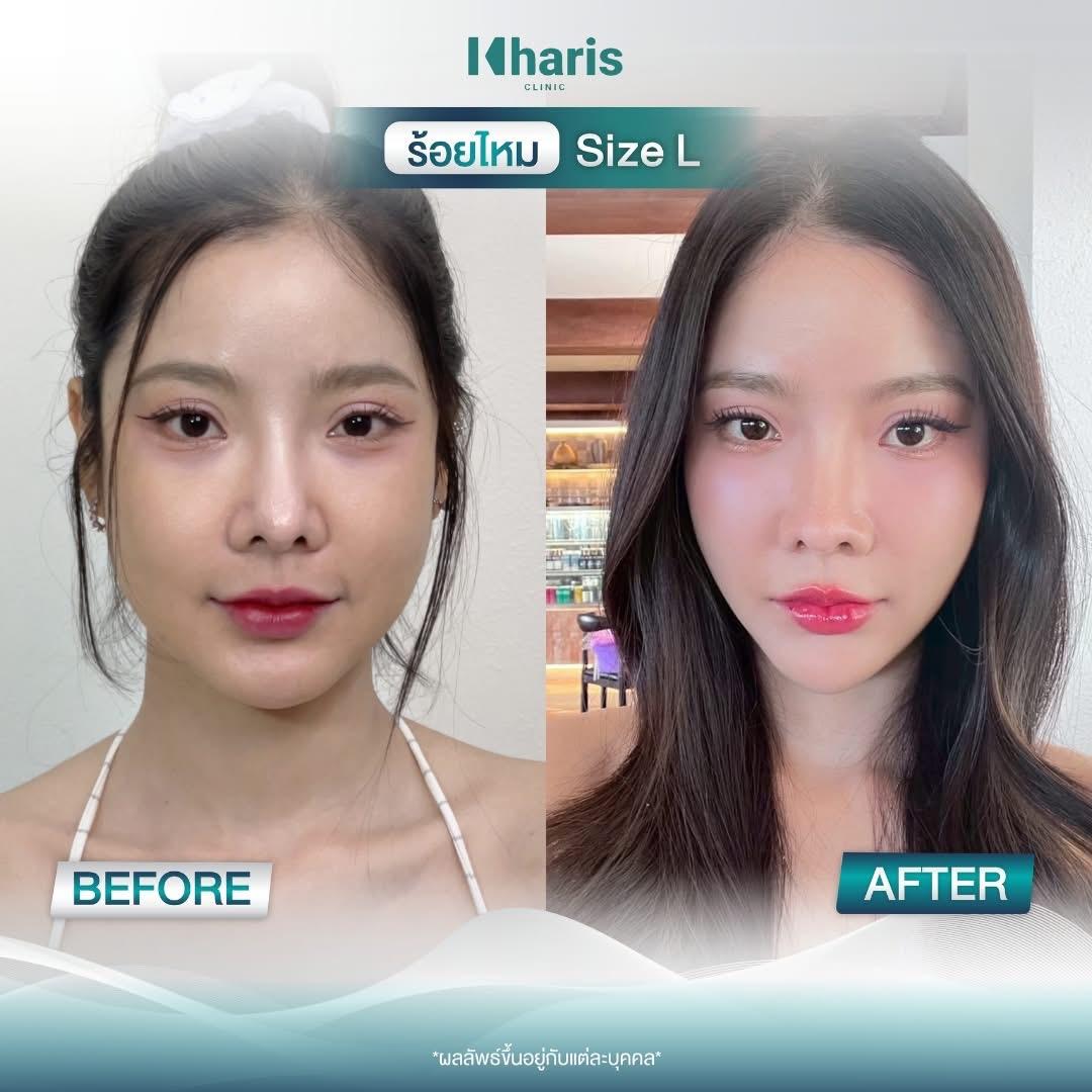 Thread Lift review 27