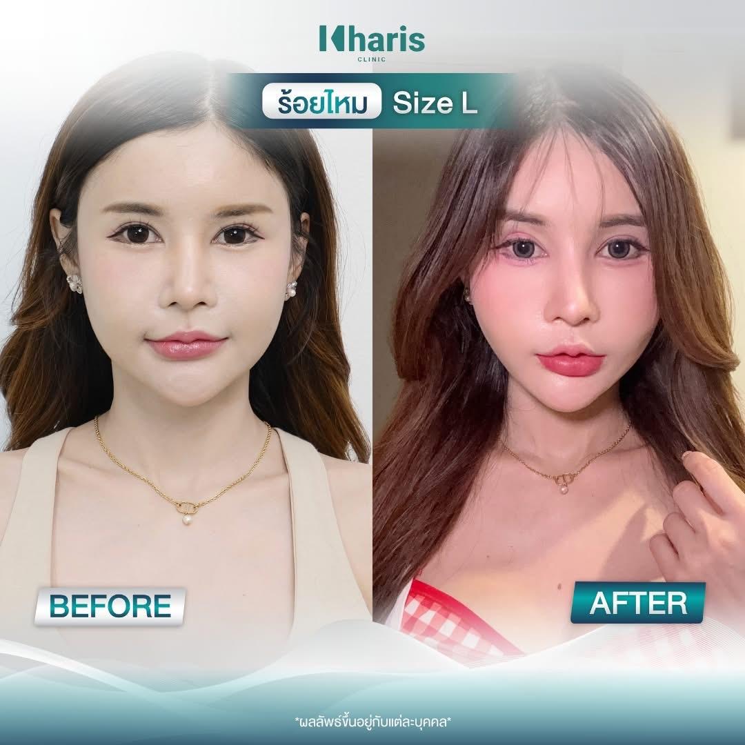 Thread Lift review 28