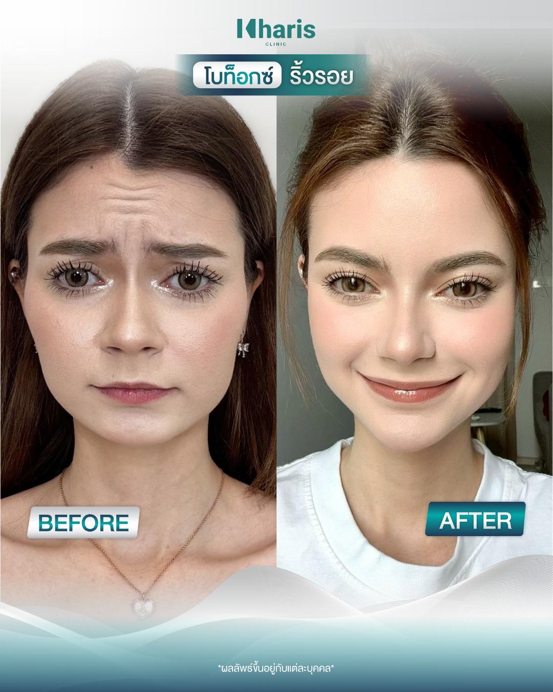 Botox review 3