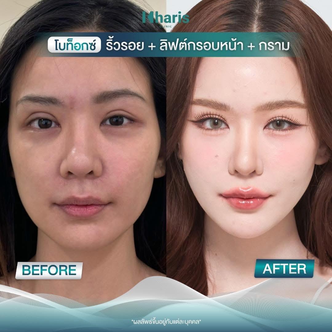 Botox review 7