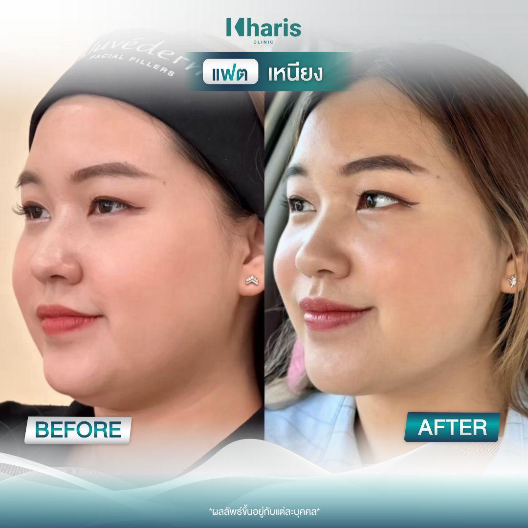 Fat Reduction review 1